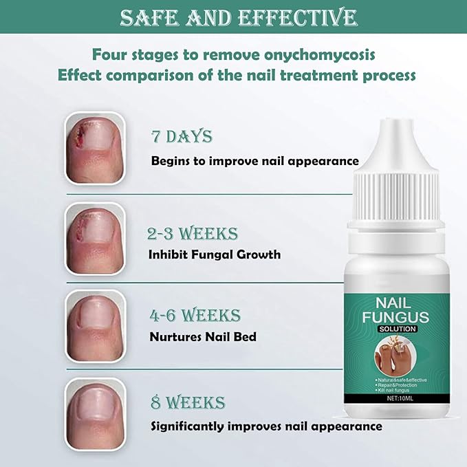 Nexusdrop Nail Fungus Solution